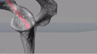 Glenoid Fracture  planing screws and guide [upl. by Snider]