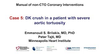 Case 5 PCI Manual  Aortic Tortuosity and DK crush [upl. by Aidua678]