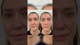 TEAR TROUGH FILLER RESULTS  DR MEDISPA [upl. by Lynad]