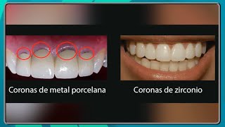 ¿Cuándo es necesario usar coronas dentales [upl. by Nireil]