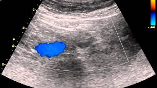 Normal abdominal aorta color Doppler transverse image [upl. by Lobell]