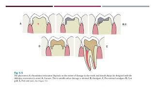 Mouth preparation in fixed prosthodontics [upl. by Nangatrad]