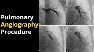 Pulmonary Angiography Procedure Angiogram Balloon Video [upl. by Adnauq]