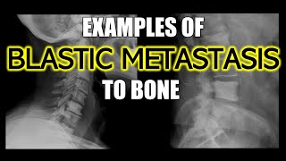 Examples of Blastic Metastasis to Bone doctor cancer bones [upl. by Folberth]