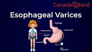 Esophageal Varices [upl. by Akirahc70]