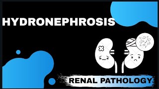 HYDRONEPHROSIS  Renal pathology   Med Bees [upl. by Odlanyar]