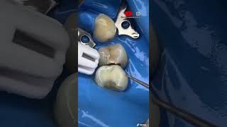 ¡🔥Eliminación de CARIES en los dientes sin DOLOR 😫🔥 [upl. by Emrich]