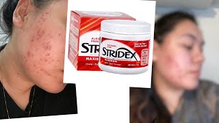 ONE MONTH USING STRIDEX PADS FOR MY ACNE [upl. by Theodoric]