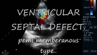 VSDPeri membranus Type ECHOCARDIOGRAPHY SERIES BY DR ANKUR K CHAUDHARI [upl. by Nevetse]