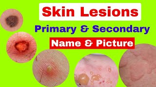 Type of skin lesions with name and picture  Primary and secondary skin lesions  skin diseases [upl. by Morril]