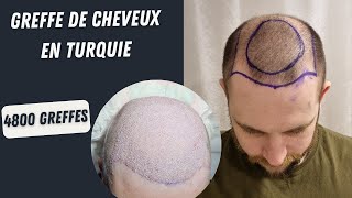 Greffe de cheveux en Turquie  Avant et après la chirurgie  greffe de cheveux 5000 greffons [upl. by Namruht707]