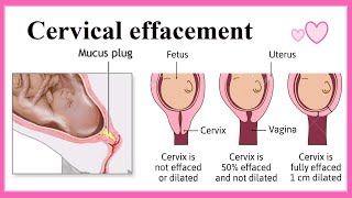 cervical effacement [upl. by Duma]