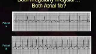 Intro EKG Interpretation Part 3 [upl. by Grenier]