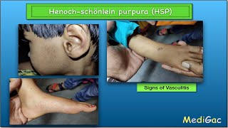 HenochSchonlein PurpuraHSP  Clinical features  Pathophysiology  Diagnosis and Treatment [upl. by Eelsnia]