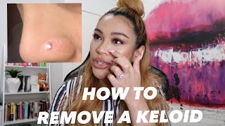 HOW I REMOVED MY NOSE PIERCING BUMP KELOID FAST [upl. by Ivie]