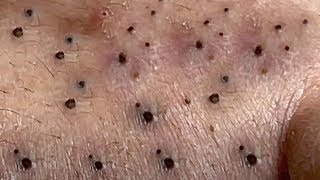 Blackheads Removal Big Acne blackheads Extraction Whiteheads [upl. by Segal]