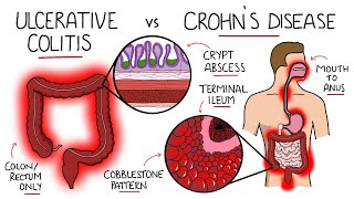 Inflammatory Bowel Disease  Ulcerative Colitis v Crohns Disease With Histology amp Manifestations [upl. by Kall]