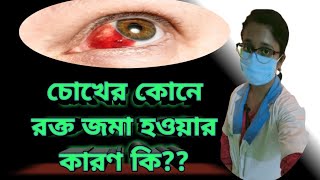 What is subconjunctival hemorrhage Causes amp Treatment in Bengali  in details [upl. by Yrogerg]