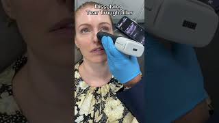 Dissolving Tear Trough Filler  Dr Medispa [upl. by Gotcher]