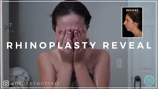 Dr Motykie Nose Job  Chin Implant REVEAL [upl. by Delfeena420]