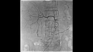 Medical Angiography  Abdominal RSMDSA Precession Mode [upl. by Ylecic]