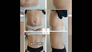 Abdominoplastie Genève  Docteure Teresa Rotunno 022 719 78 40 [upl. by Ardnosac]