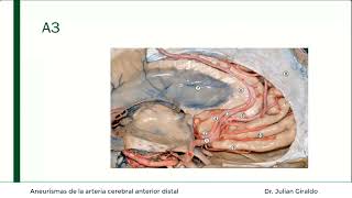 Aneurismas de la arteria cerebral anterior distal [upl. by Ynnep]