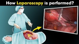 What Happens During Laparoscopy Procedure UrduHindi [upl. by Bertero]