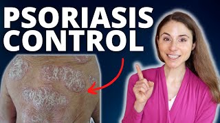 TOP 5 TIPS TO CONTROL PSORIASIS FLARES 😊 DERMATOLOGIST DrDrayzday [upl. by Alyaj]