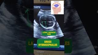 Gross Hydrocephalus in a fetusfy study fypyoutube fypシ foryou fypage trending radiology [upl. by Luzader]