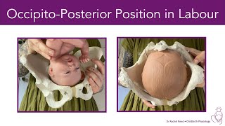 OccipitoPosterior Position BacktoBack in Labour [upl. by Lorin]