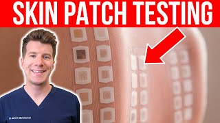 ALLERGY TESTING Doctor explains the Skin Patch Test [upl. by Oloapnaig]