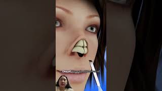 Main nasal bone correctionanimation doctor shortsvideo medicalanimation beauty [upl. by Rialcnis596]