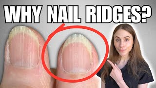 Why You Have Vertical Nail Ridges And How To Get Rid Of Them [upl. by Maleeny511]