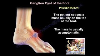 Foot and Ankle ganglion cyst  Everything You Need To Know  Dr Nabil Ebraheim [upl. by Nallij]