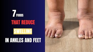 How to AVOID Swollen Ankles and Feet [upl. by Fachanan340]