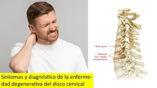 Síntomas y diagnóstico de la enfermedad degenerativa del disco cervical [upl. by Sinnard]