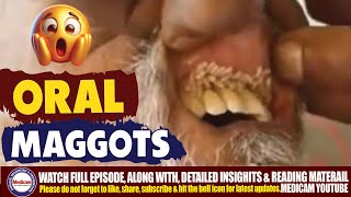 Shocking Maggots in the Mouth Oral Myiasis Causes Treatment and Prognosis 🦠🪰 [upl. by Hillinck905]