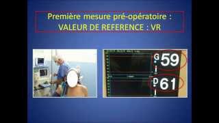 anesthésie avec ventilation spontanée et oxymétrie cérébrale dans l arthroscopie de lépaule [upl. by Eitsym]