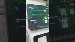 Tell me the normal ranges of vital sign shown in monitorvitalsigns monitoring pulseoximeter [upl. by Esila]