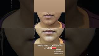 CHIN IMPLANTchinaugmentationchincontouringskincareplasticsurgerydranirbanghosh [upl. by Kizzee]