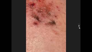 Your Skin  Morgellons Disease The Silent Pandemic Aspergillus Fumigatus [upl. by Lertnek]