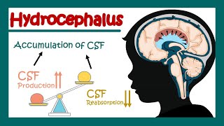 Hydrocephalus  What can cause hydrocephalus  Communicating vs non communicating hydrocephalus [upl. by Zetram]