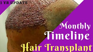 Best Hair Transplant in Nashik India  Monthwise timeline by Dr Manoj Bachhav [upl. by Esened]