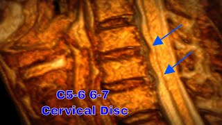 3D MRI로 보는 C56 C67 경추 디스크 이해하기 Understanding C56 C67 Cervical Disc Herniation in 3D MRI [upl. by Gnehs]