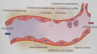 Inflammation Vascular event  Altered Vascular Permeability [upl. by Abott]