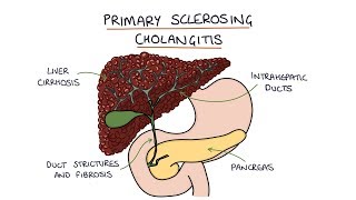 Primary Sclerosing Cholangitis Visual Explanation for Students [upl. by Esinad]