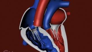 The Structure of a Heart with Transposition of the Great Arteries TGA  CHOP [upl. by Fulbright]