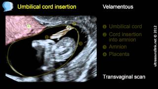 Velamentous insertion of the umbilical cord [upl. by Snevets633]