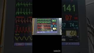 Cardiac Monitor for icu patients 🩺🏨 [upl. by Nageek]